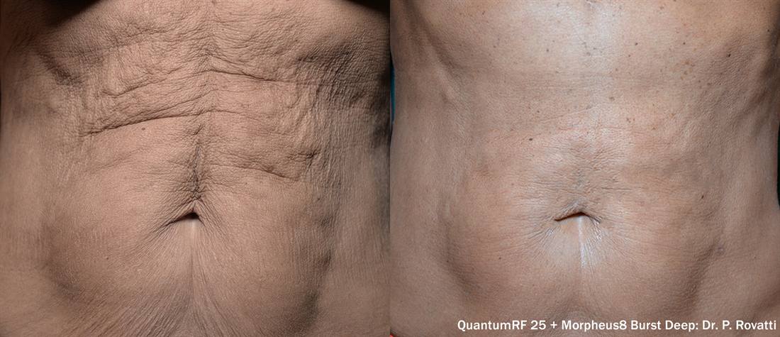 QuantumRF before and after: abdomen, loose skin. Treating physician credited on the image.