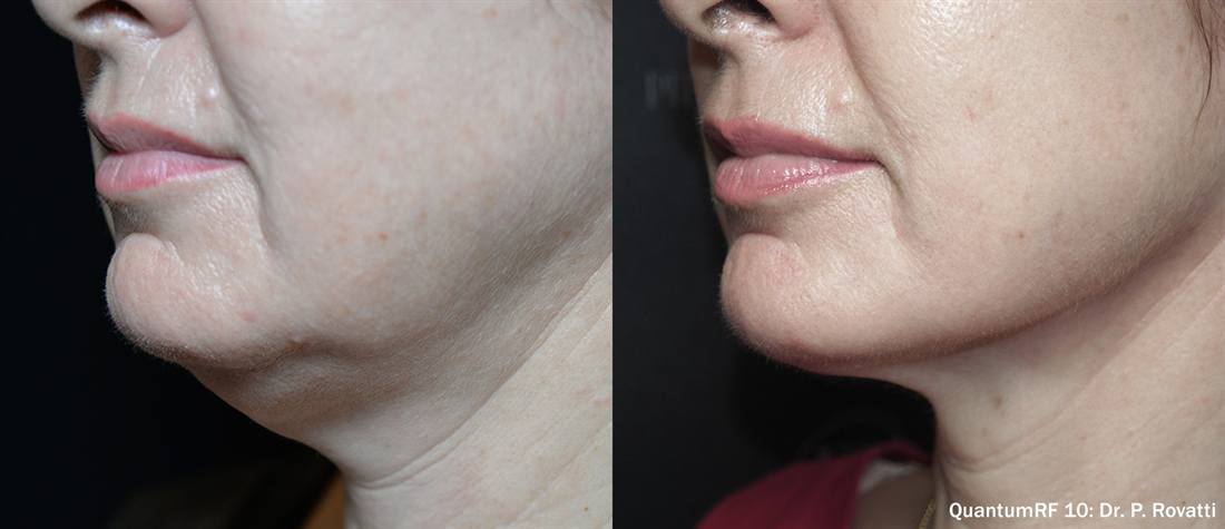 QuantumRF before and after: jawline and jowls. Treating physician credited on the image.