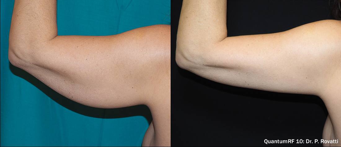 QuantumRF before and after: upper arm. Treating physician credited on the image.